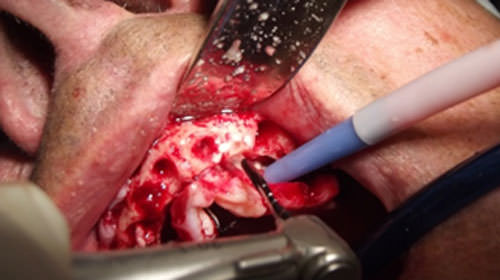 Fig.3 Osteotomía para implantes
