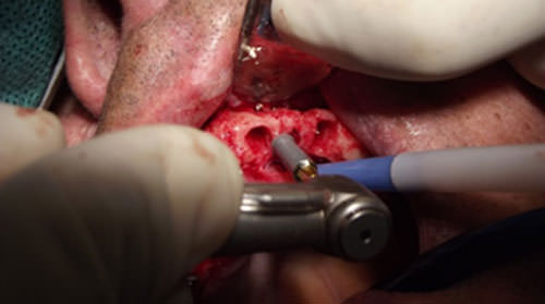 Fig.4 Inserción de implantes