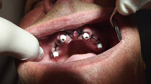 Fig.7 Capuchones de cicatrización luego de toma de impresión.