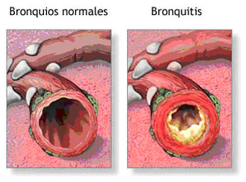 Figura 1 Ejemplo ilustrativo de la bronquitis crónica (obtenible de www.adam.com).
