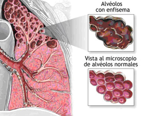 Figura 2 Ejemplo ilustrativo del enfisema pulmonar (obtenible de www.adam.com)..