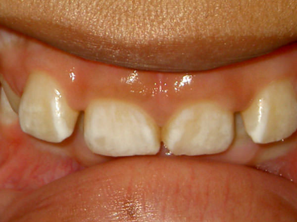 Foto 1 Hipoplasia de esmalte generalizada