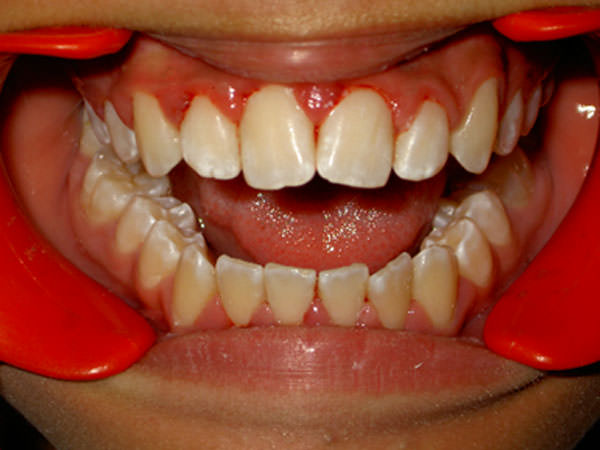 Foto 3 Hipoplasia de esmalte y gingivitis