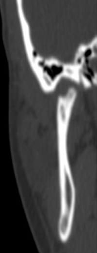 Figura 5 Tomografía Computada de ATM derecha, corte coronal. Se distingue la pronunciada pérdida de volumen condilar, ausencia de anatomía y aumento de mineralización del tejido óseo trabecular remanente.