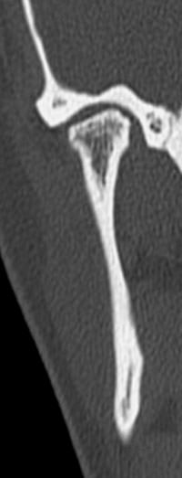 Figura 1 Tomografía computada de ATM derecha, corte coronal: Llama la atención la asimetría de formas óseas, caracterizada por el aplanamiento del apex condilar acompañado de irregularidad del contorno óseo cortical condilar.