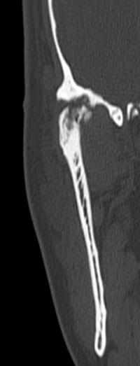 Figura 2 Tomografía computada de ATM derecha, corte coronal: en la imagen se visualiza la gran destrucción de los tejidos óseos destacando la irregularidad de la anatomía condilar y de cavidad glenoidea, presencia de áreas pseudoquísticas en zona alta y visualización de osteofitos en polo medial.