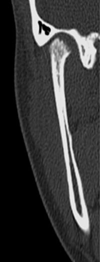 Figura 3 Tomografía computada de ATM derecha corte coronal: destaca la pérdida del volumen condilar, en relación a forma y tamaño de cavidad glenoida, acompañado de esfumado de corticales y aumento de la mineralización del tejido trabecular subyacente, sin compromiso del temporal.