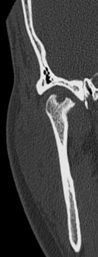 Figura 4 ATM derecha, Tomografía computada corte coronal: se visualiza marcada pérdida de anatomía condilar, con pérdida de estructura ósea central de apex e irregularidad de polo medial.