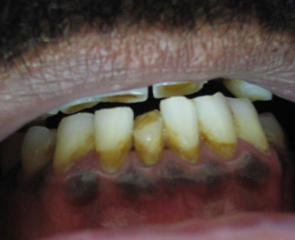Figura 1 Melanosis asociada al tabaquismo. Máculas parduzcas en encía adherida de zona antero-inferior.