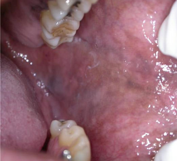 Figura 2 Melanosis asociada al tabaquismo. Máculas parduzcas generalizadas, detalle de carrillo.
