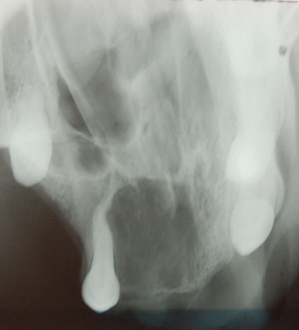 Fig 1 Radiografía Oclusal. Lesión mixta en pompas de jabón, nótese estrecha relación con el diente 1.6.