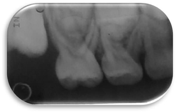 Figura 3 Rx periapical superior derecha