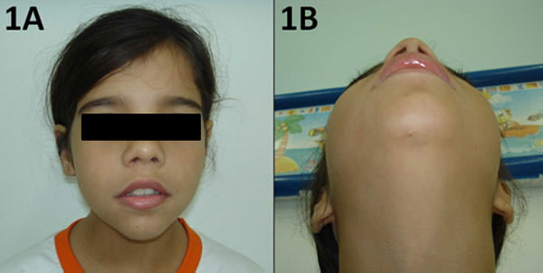 Figura 1 Examen extraoral. A, B - Tunefación indolora en el lado derecho del cuerpo de la mandíbula.