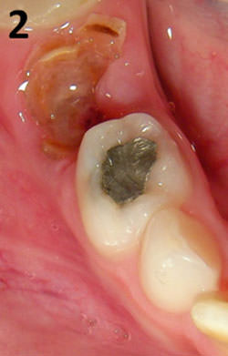 Figura 2 Examen intraoral. Resto radicular del segundo molar inferior primario derecho.