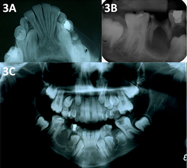 Figura 3 Examen radiográfico. A - Radiografía oclusal, mostrando expansión ósea vestibular en la región mandibular inferior derecha en contacto con el segundo molar inferior primario. B, C - Radiografía periapical y panorámica revelando una área circular radiolúcida, única, bien definida y amplia, con 15 mm de diámetro, en íntima asociación con la región periapical del segundo molar inferior primario derecho, la ausencia del segundo premolar inferior derecho y la presencia del segundo premolar inferior izquierdo malformado.