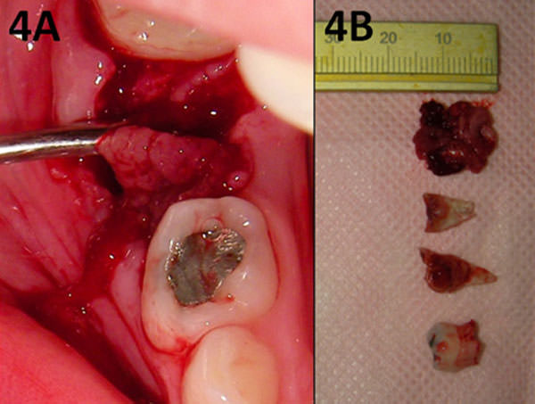 Figura 4 Tratamiento quirúrgico. A - Enucleación de la lesión intraósea, que mostró hemorragia moderada. B - La muestra tejidual con 15 x 15 mm, fragmentos radiculares del segundo molar primario asociado a la lesión y el primer molar primario con reabsorción fisiológica extensa también extrajo.