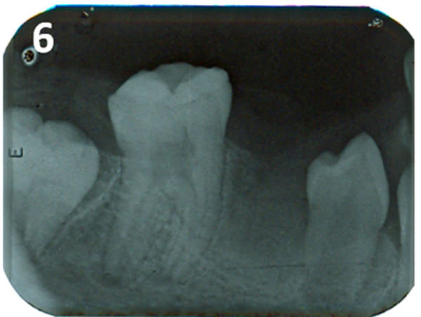 Figura 6 Seguimiento del caso. Radiografía periapical en 3 meses mostró una buena cicatrización postquirúrgica del defecto óseo después de la eliminación de la lesión inflamatoria
