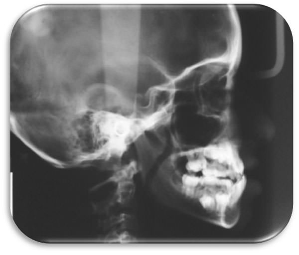 Imagen Nº 7 Radiografía cefálica lateral inicial. Nótese morfología craneofacial