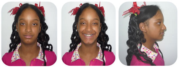 Imgen Nº 10: Fotos Extraorales Finales. Frente (Fig a) Sonrisa (Fig b) y Perfil (Fig c)