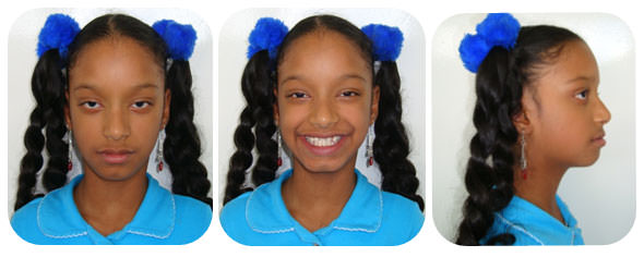 Imagenes Nº 1 Fotos Extraorales Iniciales Frente (Fig a) Sonrisa (Fig b) y Perfil (Fig c). Nótese el biotipo dolicofacial, perfil ligeramente convexo e hipertelorismo intercantal