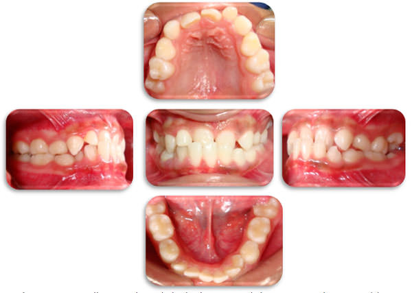 Imágenes Nº 2 Fotos clínicas iniciales. Maloclusión Clase I tipo 3. Obsérvese arcos asimétricos y mordida cruzada anterior, retrusión de incisivos superiores e inferiores