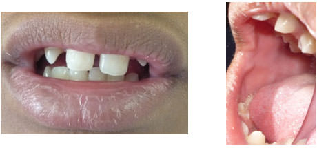 Imágenes Nº 3 Lesiones asociadas al SRC Queilitis descamativa labial y lesiones fibrosas en los carrillos (pag 10)