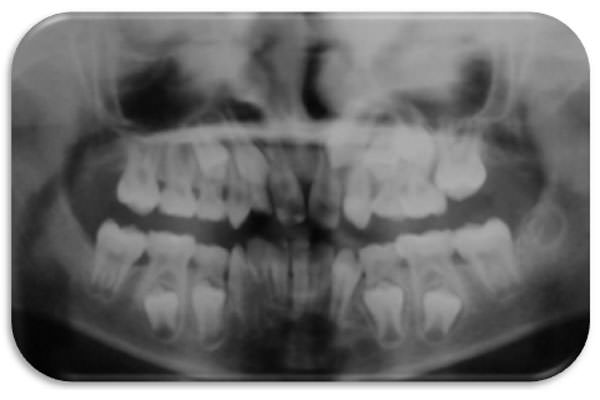 Imagen Nº 4 Radiografía panorámica inicial. Nótese ologodoncias de 10 gérmenes dentarios, erupción ectópica mesial del 26 y áreas apicales medias y anteriores superiores comprimidas