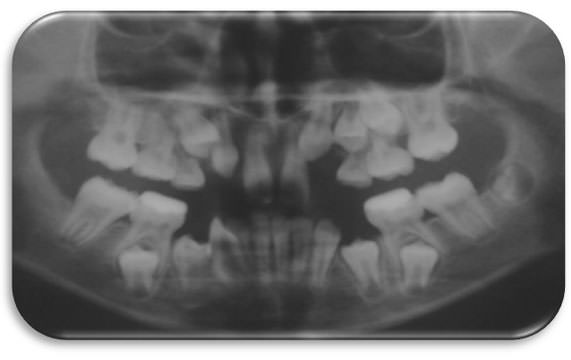 Imagen Nº 5 Primer control radiográfico luego de exodoncias guiadas, expansión anterior y pistas planas