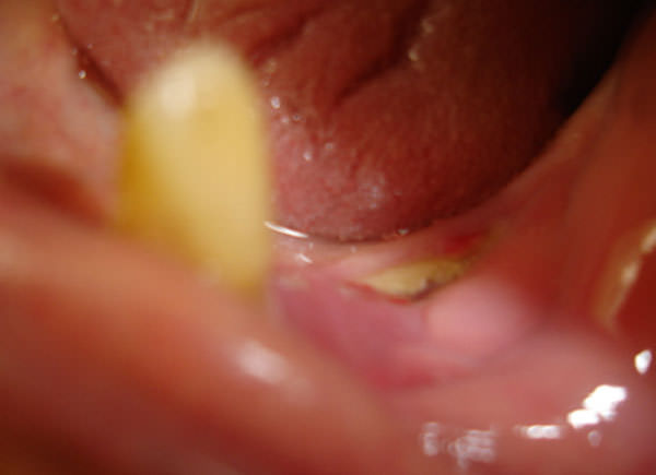 Fig. 2 Post-operatorio de la toma de biopsia incisional. Tomada de caso clínico Profa. Martha Espinoza