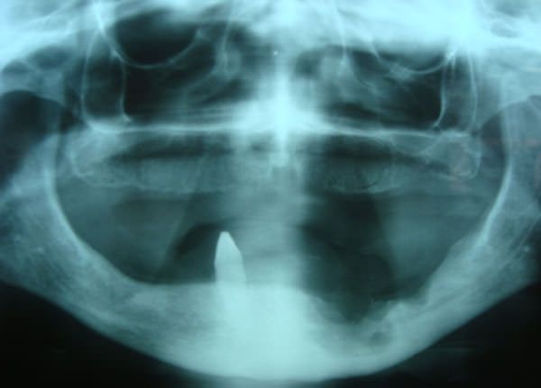 Fig. 11 Radiografía panorámica 6 meses después de la resección marginal y el relleno con PRP. Tomada de caso clínico Profa. Martha Espinoza