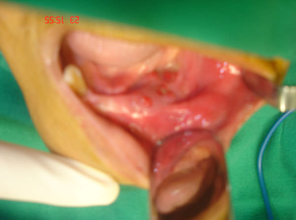 Fig. 4 Multiples fístulas intra bucal en reborde alveolar inferior lado izquierdo. Tomada de caso clínico Profa. Martha Espinoza