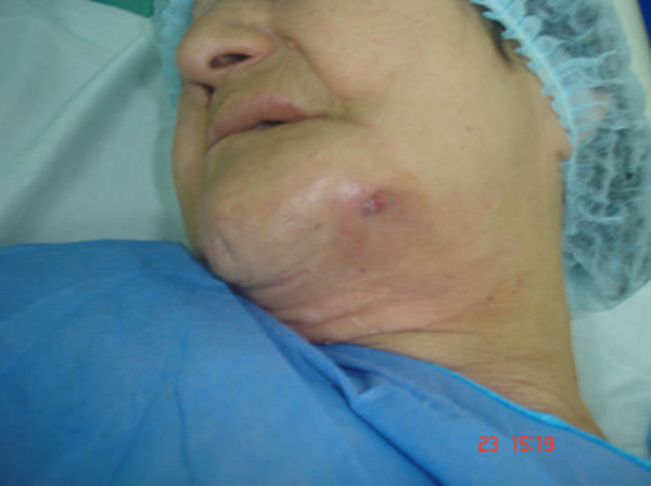 Fig. 5 Fístula extra bucal con contenido purulento. Tomada de caso clínico Profa. Martha Espinoza