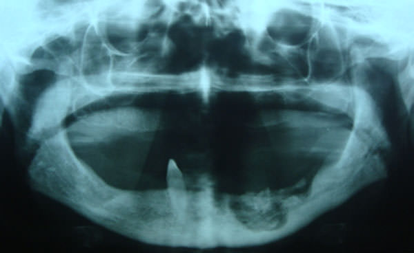 Fig. 6 Radiografía panorámica antes de realizar resección marginal mandibular. Tomada de caso clínico Profa. Martha Espinoza