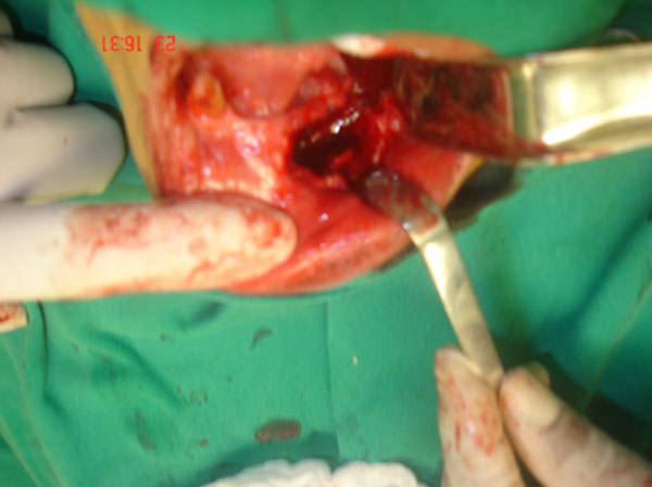 Fig. 7 Resección marginal mandibular. Tomada de caso clínico Profa. Martha Espinoza