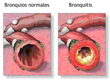 Figura 1 Ejemplo ilustrativo de la bronquitis crónica (obtenible de www.adam.com).