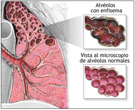 Figura 2 Ejemplo ilustrativo del enfisema pulmonar (obtenible de www.adam.com).