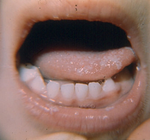 FIGURA 1: Lesiones blanquecinas en labios y boca de Candidiasis. (Cortesía Dra. Sofía Mata. Sección de Micología, IMT)