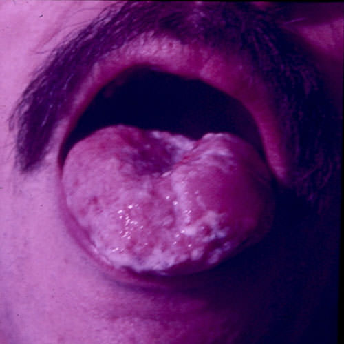 FIGURA 2: Candidiasis Hiperplásica en lengua (Cortesía: Profa. Carmen Marcano, Sección Micología Médica-IMT)