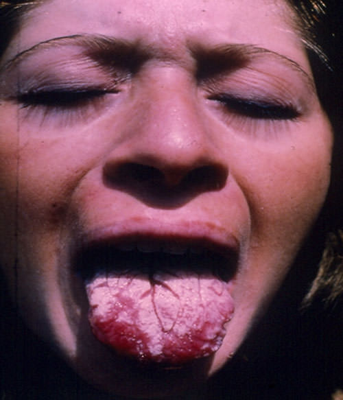 FIGURA 3 Glositis Rómbica por Candida (Cortesía: Profa. Carmen Marcano, Sección Micología Médica-IMT)