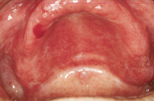 FIGURA 4 Estomatitis Sub-Protésica Tipo II en paladar (Cortesía Profa. Elba Cardozo)