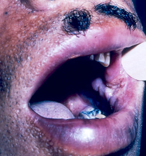 FIGURA 5 Lesión ulcerosa en carrillo de Paracoccidioidomicosis (Cortesía: Profa.. Carmen Marcano, Sección Micología Médica-IMT)
