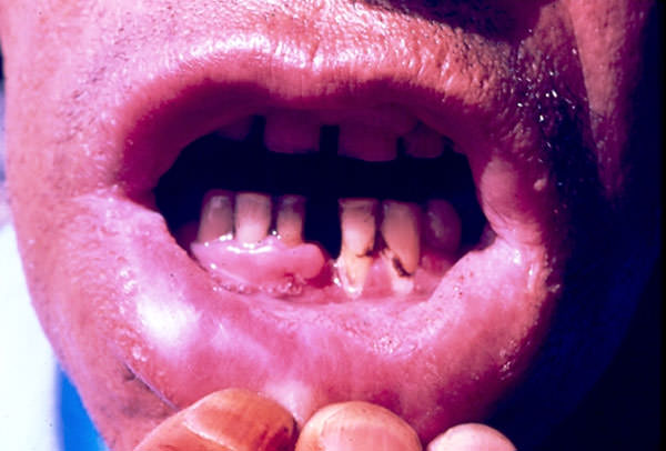FIGURA 7 Lesiones granulomatosas en mucosa vestibular y úlcera en encía inferior de Paracoccidioidomicosis. (Cortesía: Profa. Carmen Marcano, Sección Micología Médica-IMT)