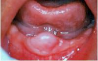 Fig 2 vista bucal del fibroma