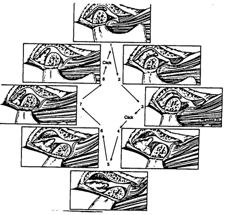 Figura 2: Dislocación de disco con Reducción: Representación Diagramática (Tomado de J.P. Okeson. Management of Temporomandibular Disorders and Occlusion)
