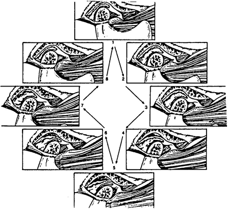 Figura 3: Dislocación de disco sin Reducción: Representación Diagramática (Tomado de J.P. Okeson. Management of Temporomandibular Disorders and Occlusion)