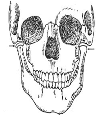 Figura 4: Alteraciones en Forma y Función de la Articulación Temporomandibular. Inestabilidad ortopédica de la articulación, causante de desórdenes Temporomandibulares (Tomado de J.P. Okeson. Management of Temporomandibular Disorders and Occlusion)