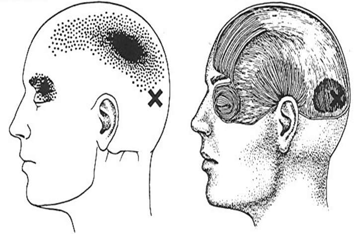 Figura 6: Dolor Miofacial Observese la distribución de los puntos de Gatillo (Tomado de J.P. Okeson. Management of Temporomandibular Disorders and Occlusion)