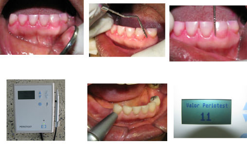Figura 1 Parámetros de evaluación periodontal empleados: Índice de Placa, Inflamación Gingival, Profundidad de Surco Gingival y VPT.