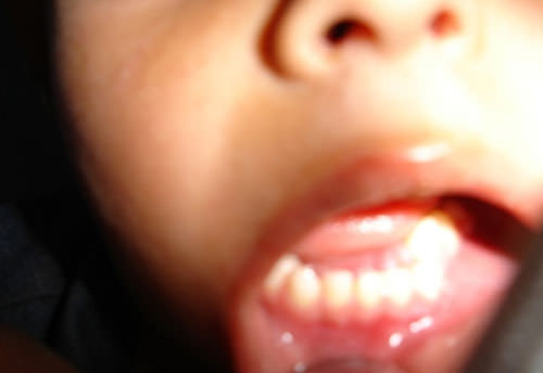 Figura 1 Fractura preoperatorio.
