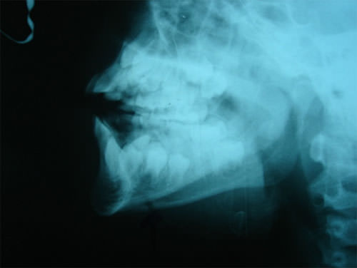 Figura 2 Rayos x preoperatorio.